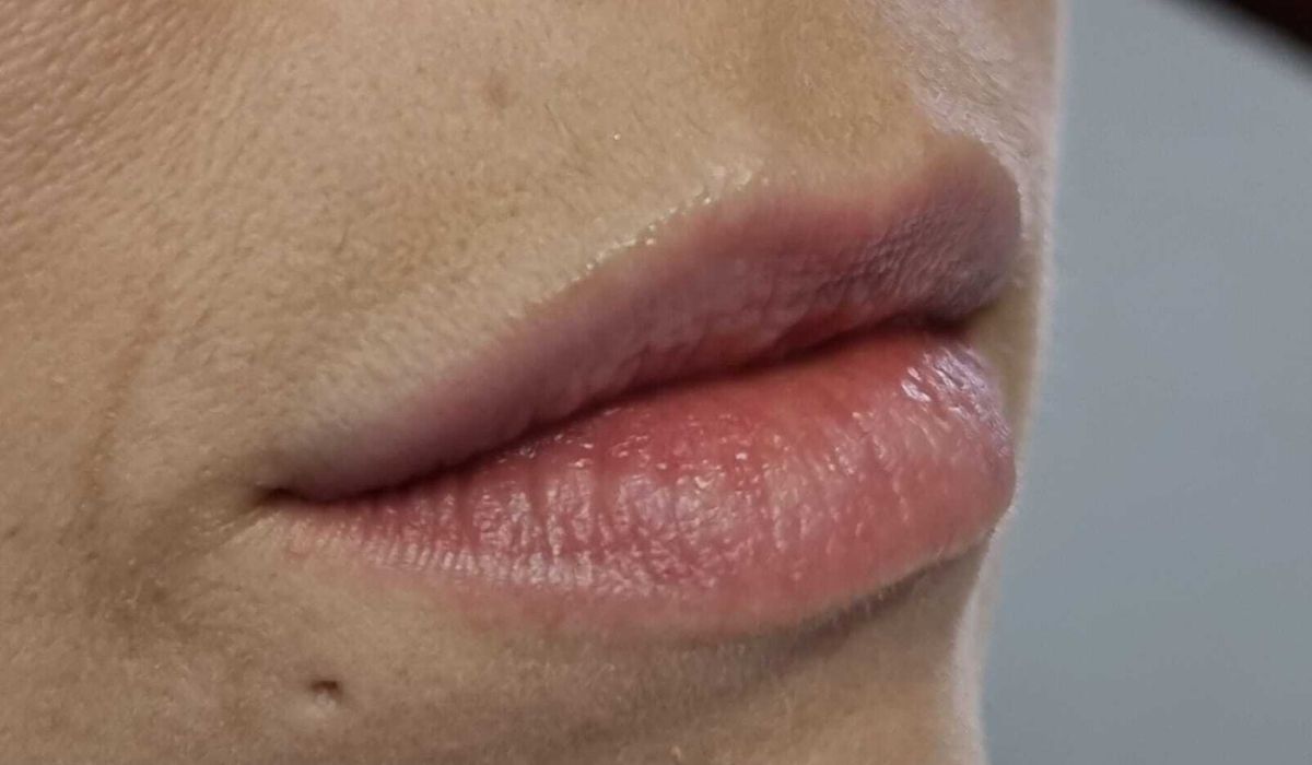 Labios 1 Antes