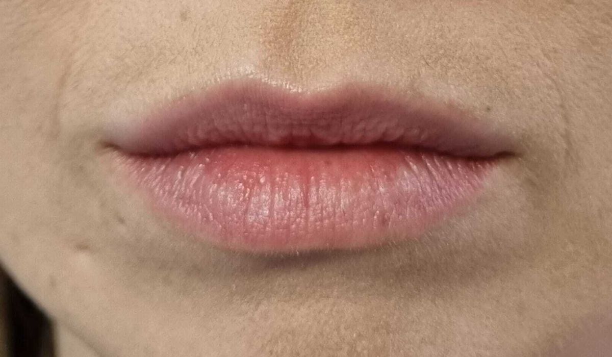 Labios 3 Antes